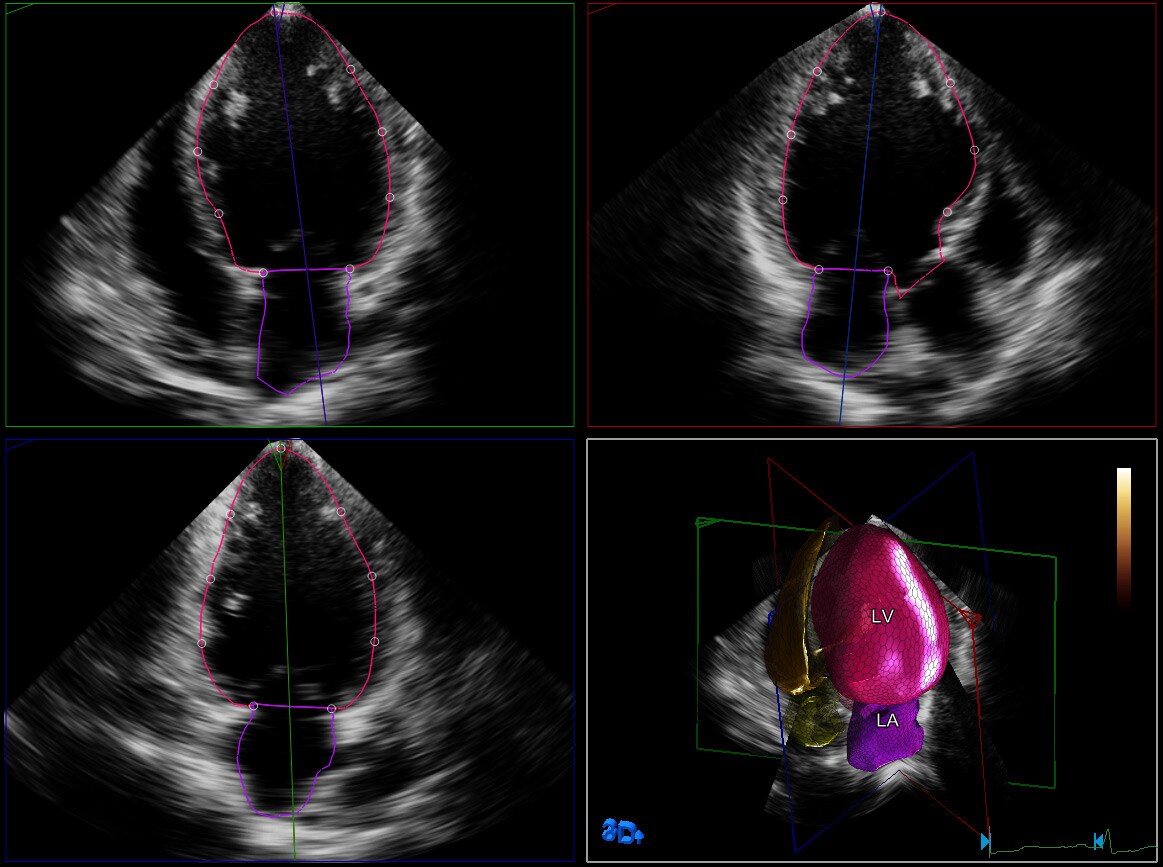 cuantificación ecocardiográfica transtorácica 3D
