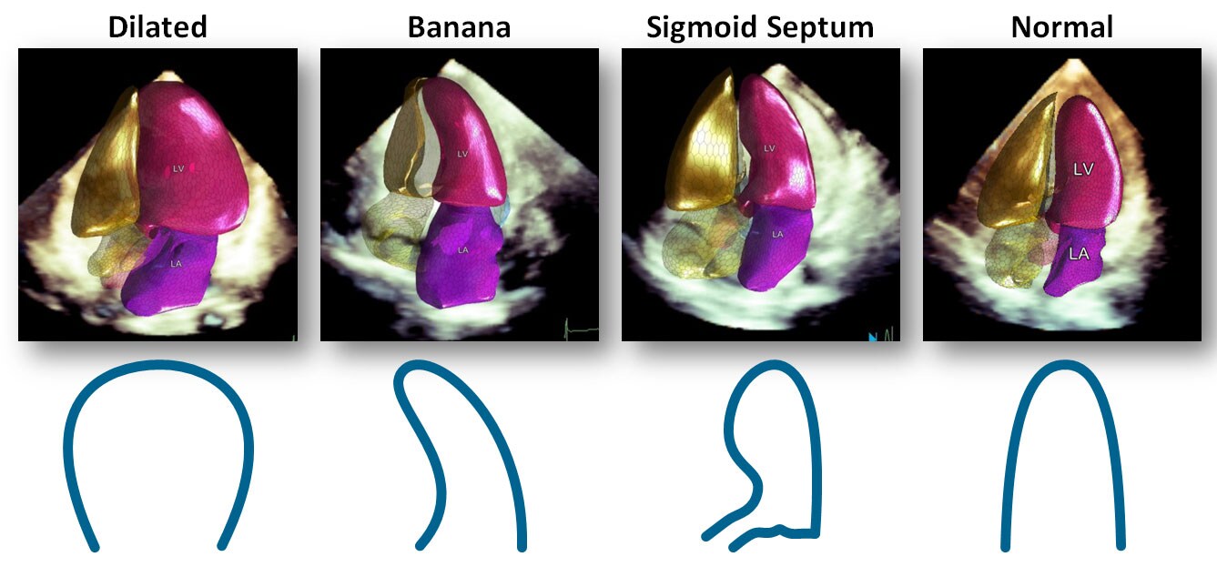 cuantificación ecocardiográfica