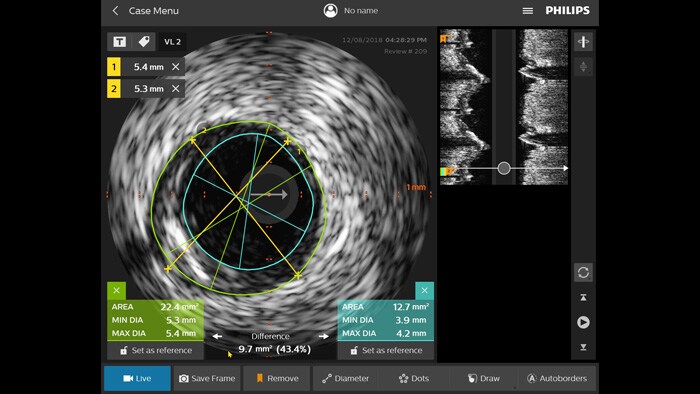 Ecografía intravascular (EIV)