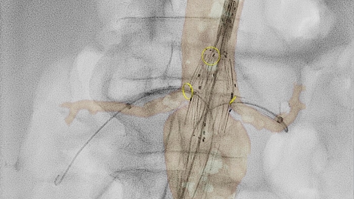 Vista en miniatura de la perfusión vascular 2D