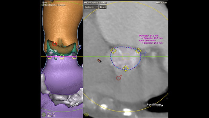 Imagen clínica Philips HeartNavigator