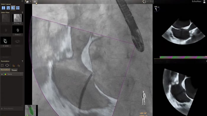 Modelos EchoNav aorta-mitral