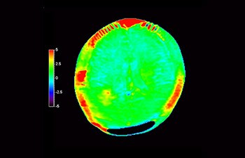 Recidiva del glioblastoma