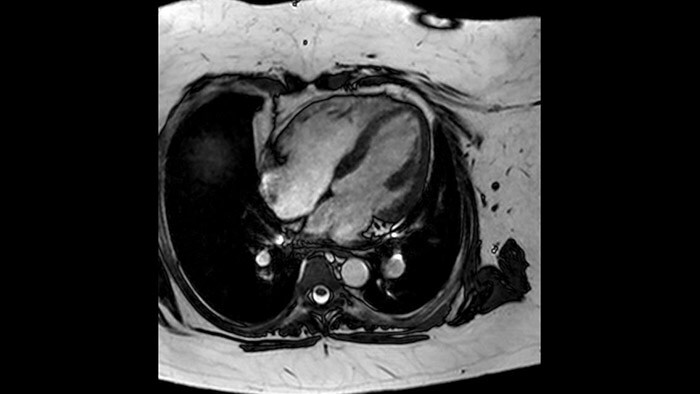 bTFE 4 chamber view obese patient (download .jpg)