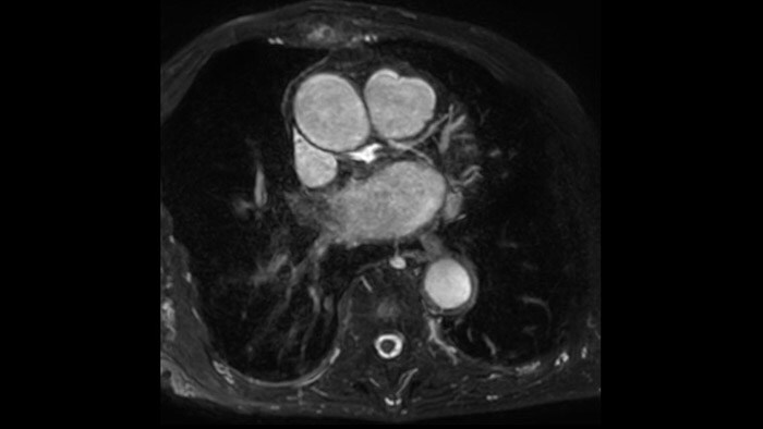 Coronaries LCX (download .jpg)