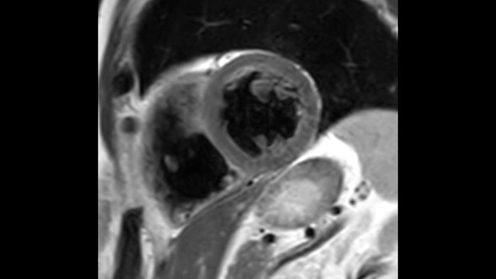 T2w TSE Black Blood Compressed SENSE (download .jpg)