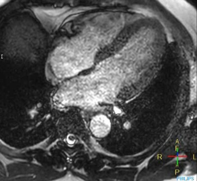 Imágenes cardiacas de aceleración convencional PHH