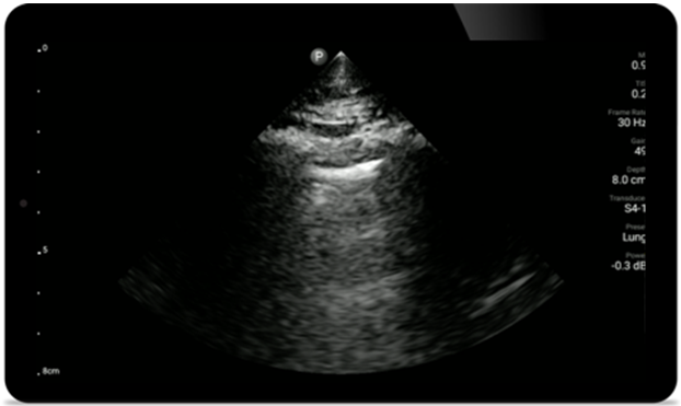 Evaluación pulmonar