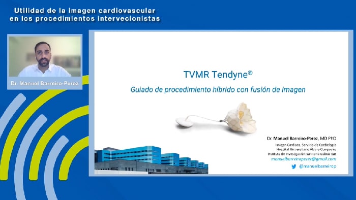 Procedimiento de implante de válvula mitral Tendyne transapical hibrido (Transcateter + Cirugía Cardiaca) con fusión de imagen - Dr. Manuel Barreiro Pérez