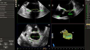 Válvula Mitral Navigator proporciona cálculos en tan sólo unos pocos pasos fáciles y rápidos.