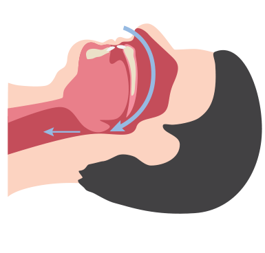 Vías respiratorias obstruidas