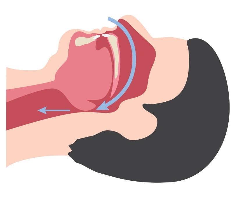 Vía respiratoria obstruida