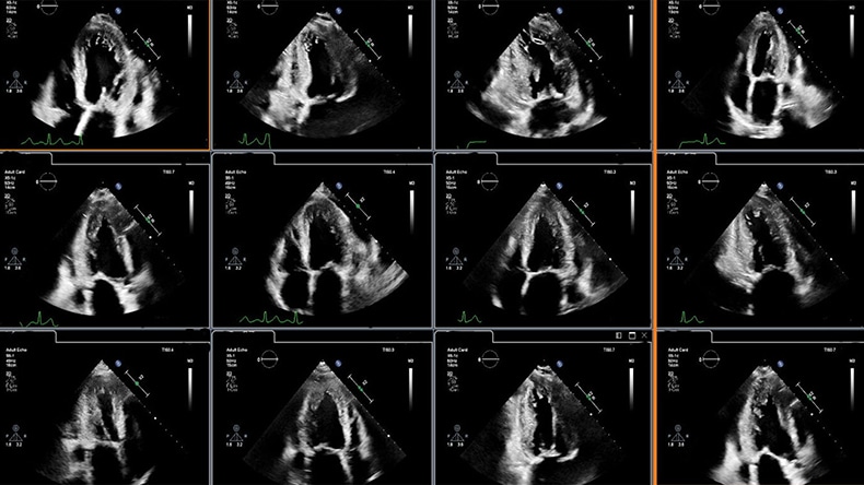 Clinical image showing cardiac ultrasound display for image analysis enhanced through integration of AI