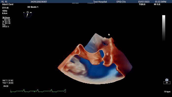 3D view of adult left atrial appendage